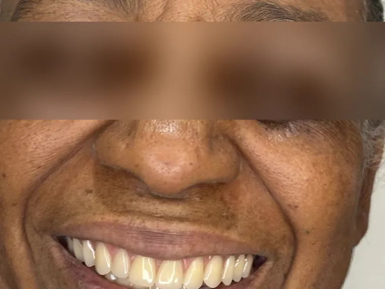 Sorriso de paciente, identidade preservada.
